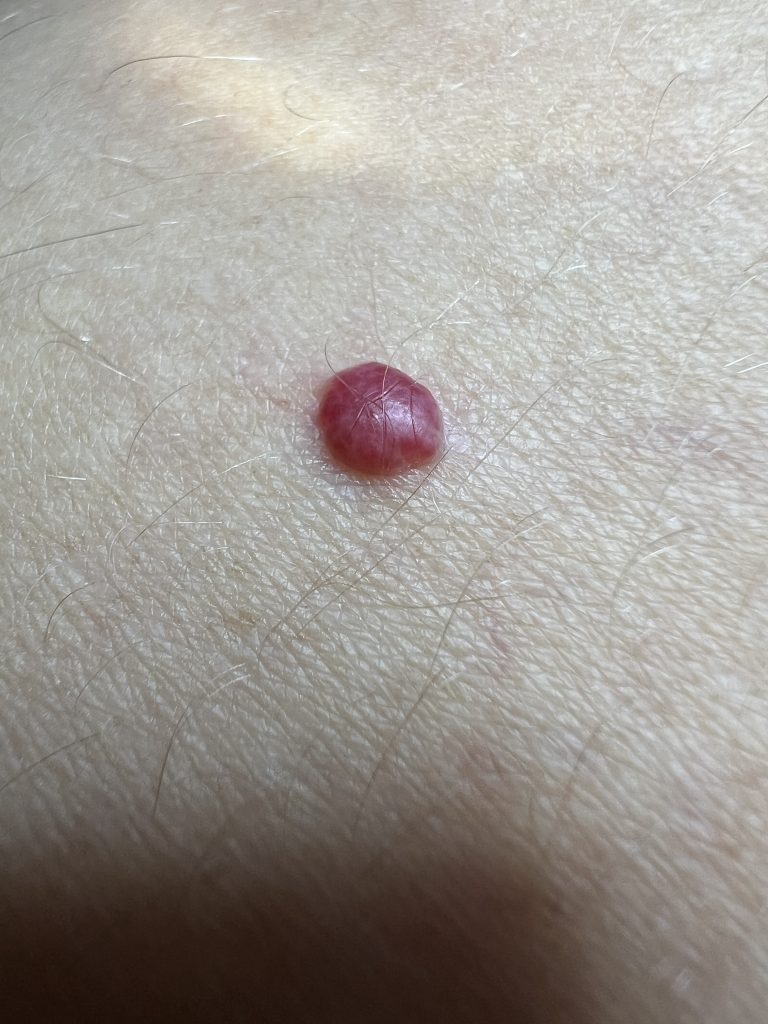 Large Blood Spot