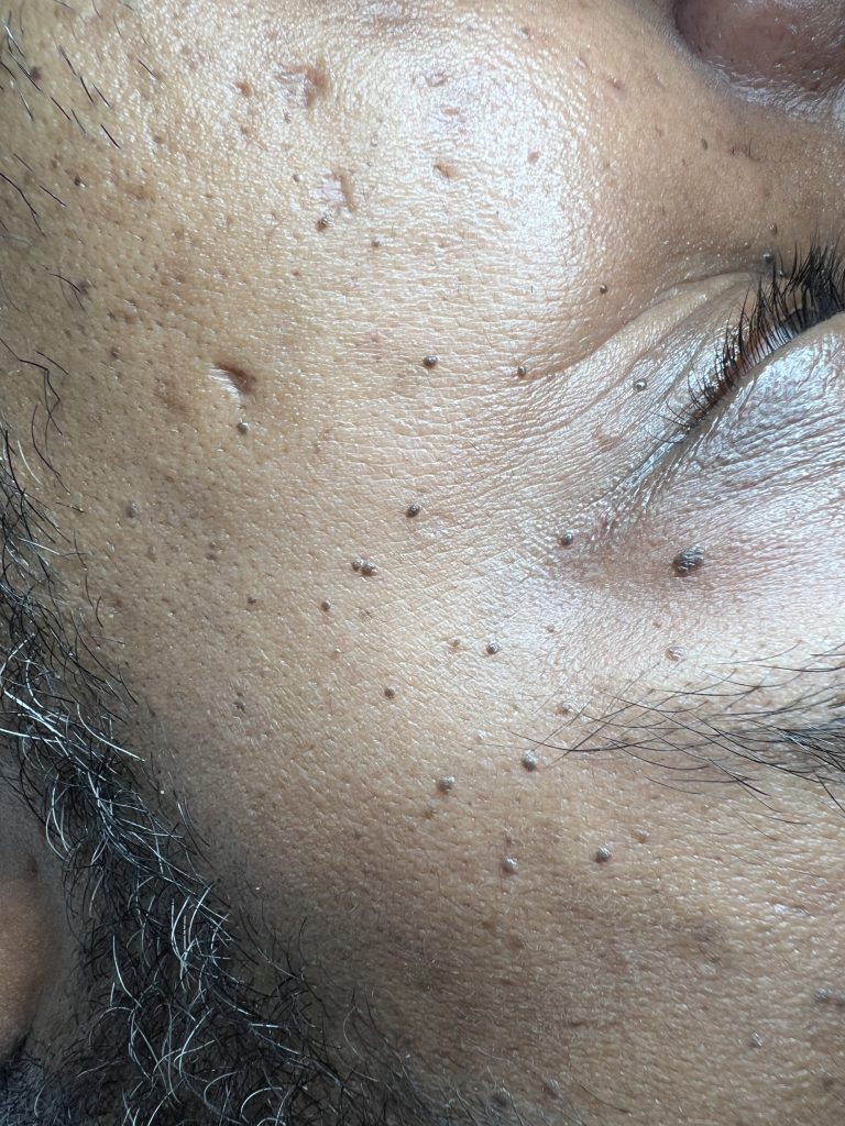 Dermatosis Papulosa Nigra
