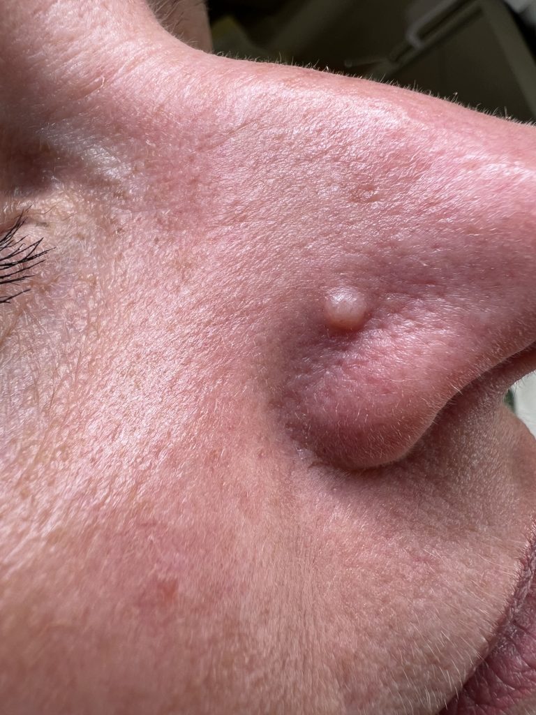 Fibrous Papule Removal