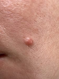 facial mole
