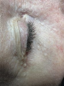 syringoma removal colchester and chelmsford