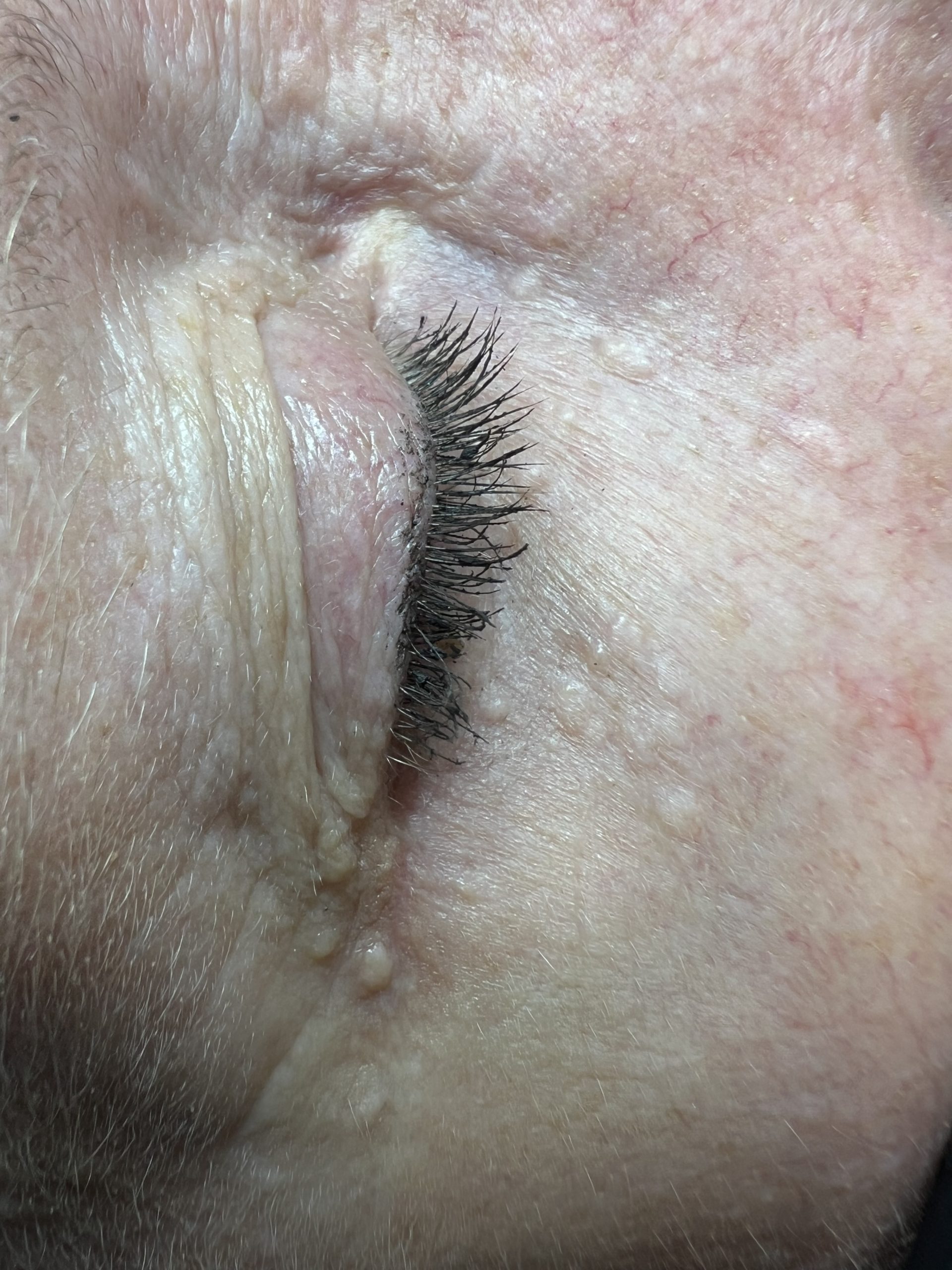syringoma removal colchester and chelmsford
