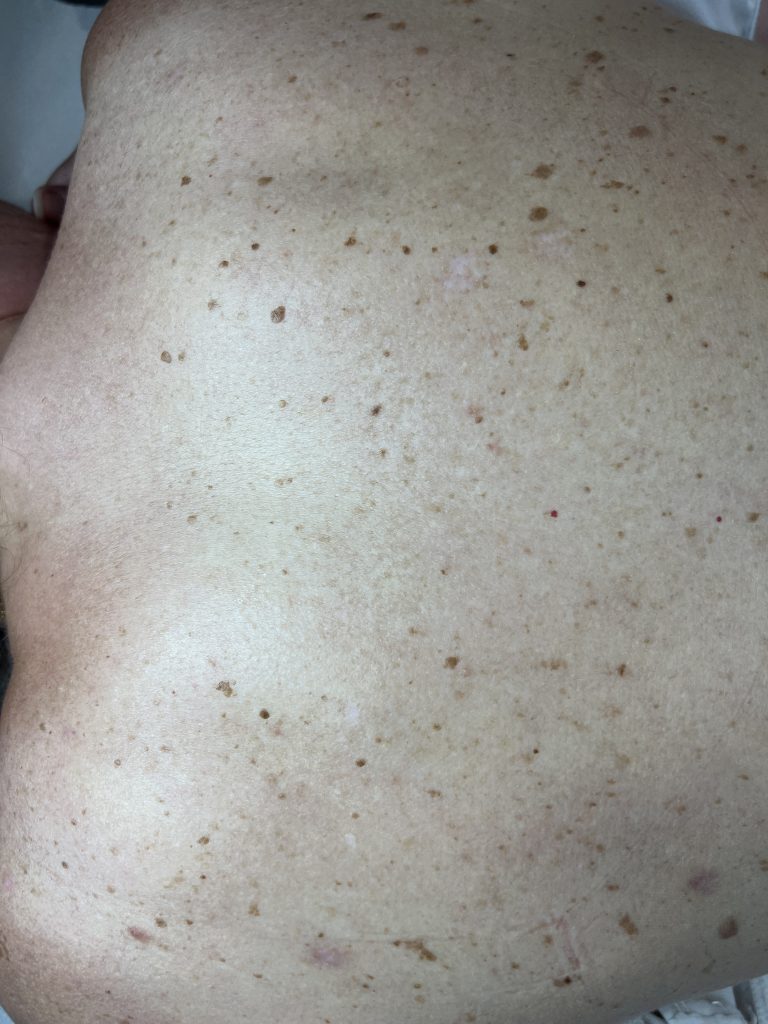 Seborrheic Keratosis Removal Mulitiple