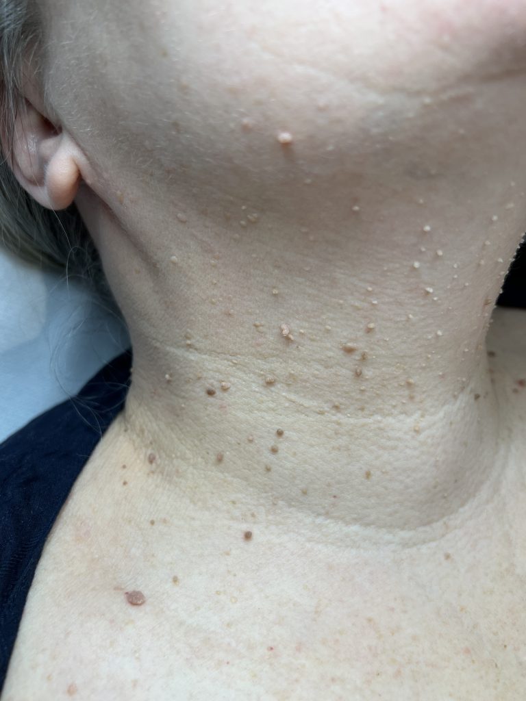 SKIN TAG MULTIPLE SMALL