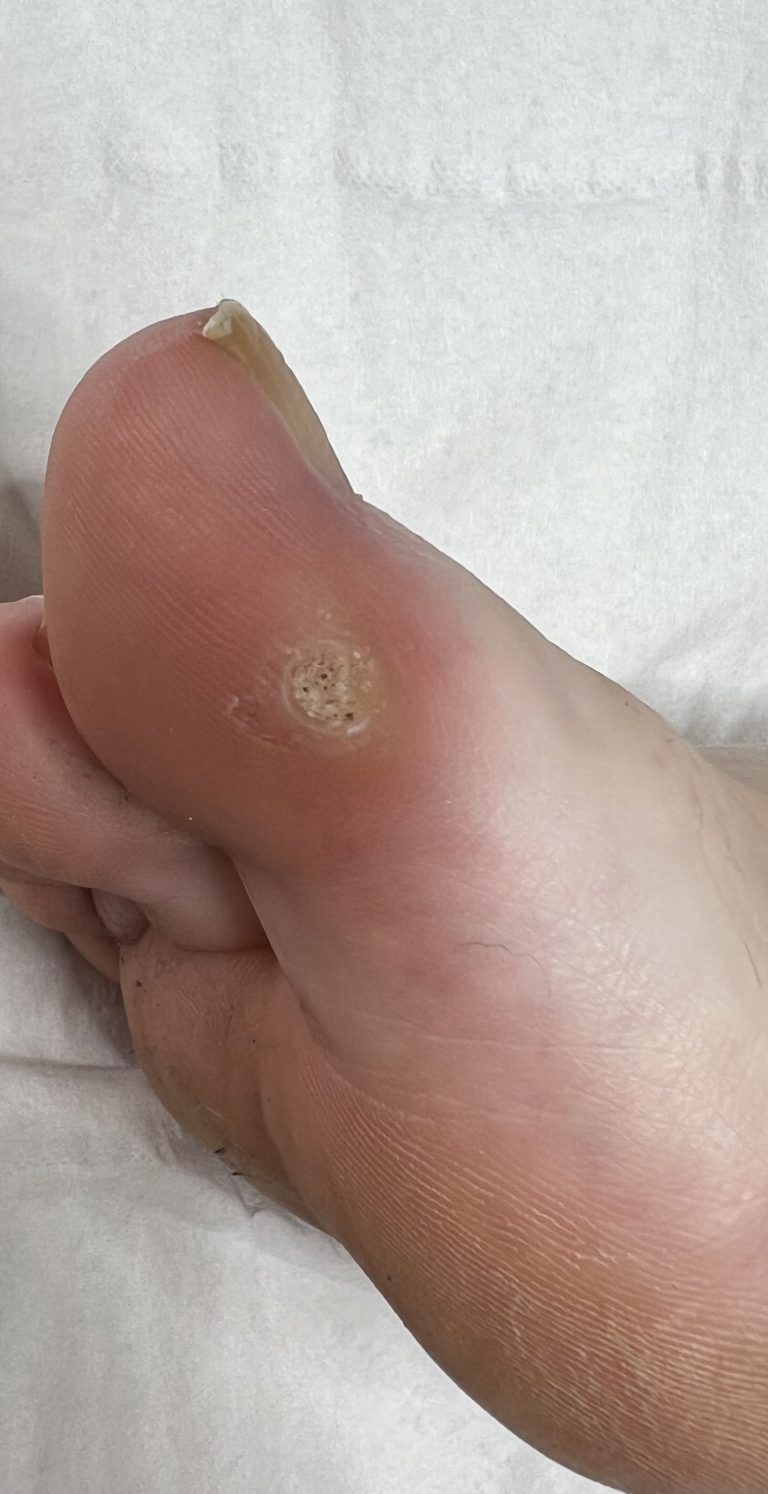 Verruca Treatment
